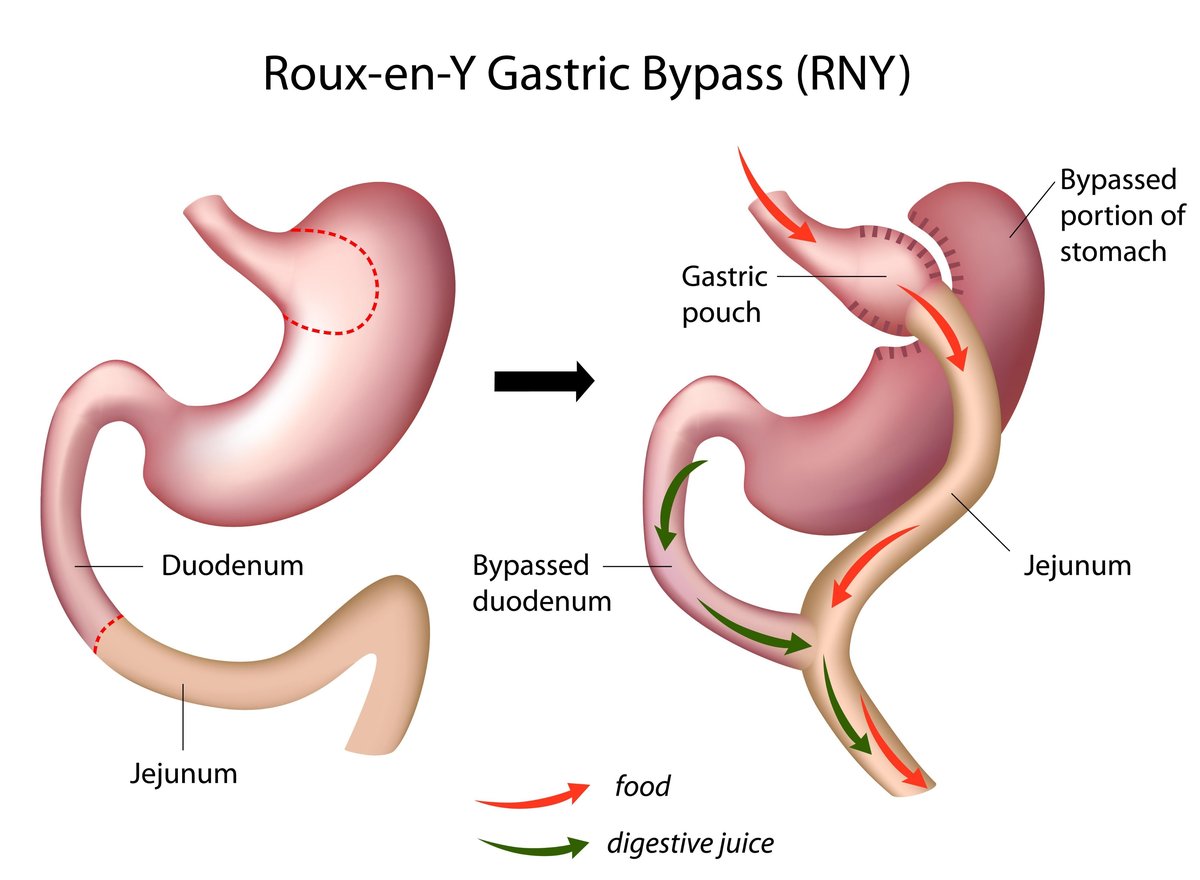 Educational diagram of Roux-en-Y gastric bypass showing a small stomach pouch and rerouted intestine